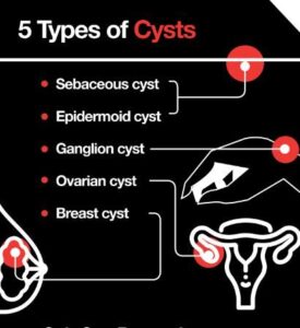 types-of-cyst